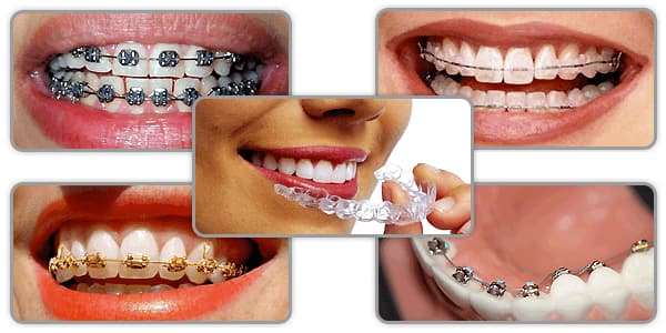 أشهر أنواع تقويم الأسنان