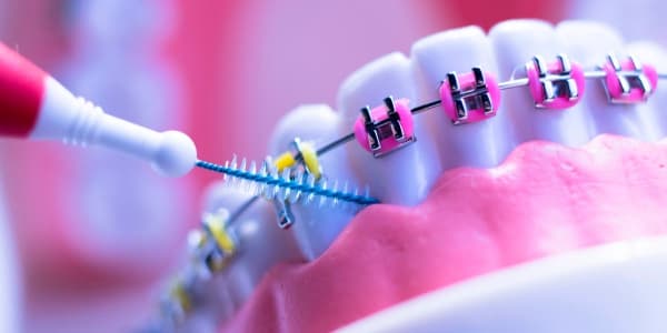 طريقة العناية بالأسنان خلال فترة التقويم