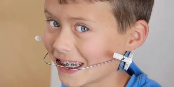 فوائد تقويم الأسنان للأطفال