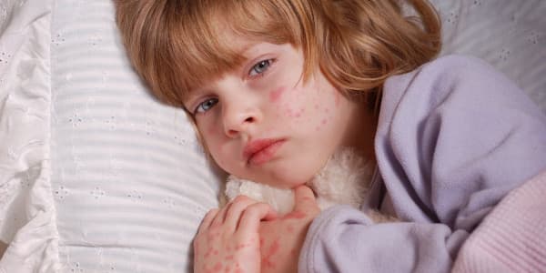 أعراض حساسية الجلد عند الأطفال