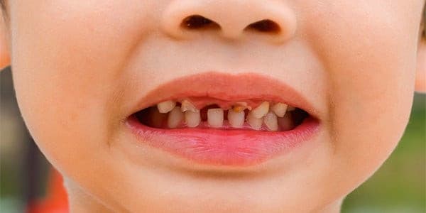 اشكال تهري الأسنان عند الأطفال