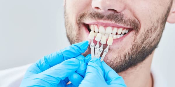 إجراءات الفينير للأسنان